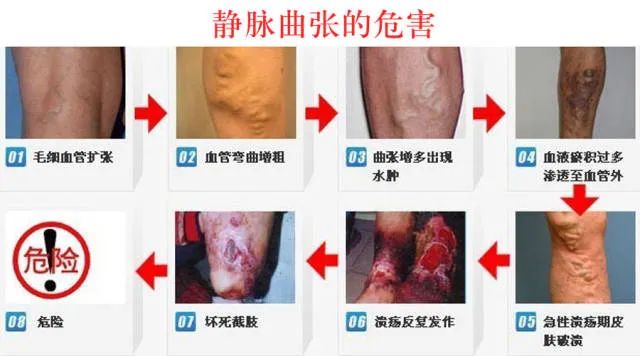 静脉曲张：.jpg